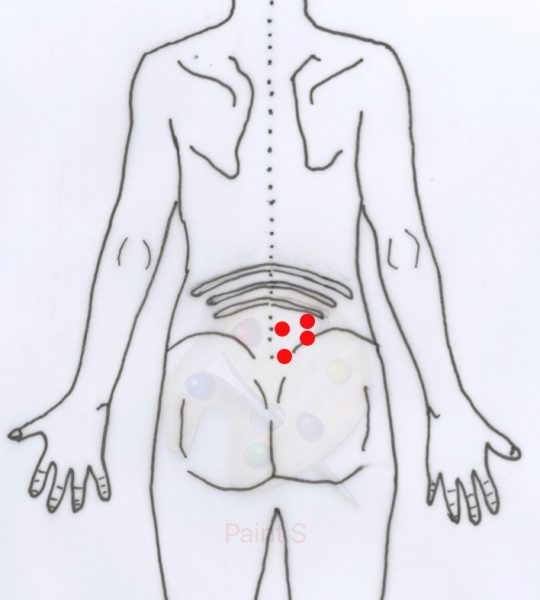Spoušťové body ve svalu q. lumborum